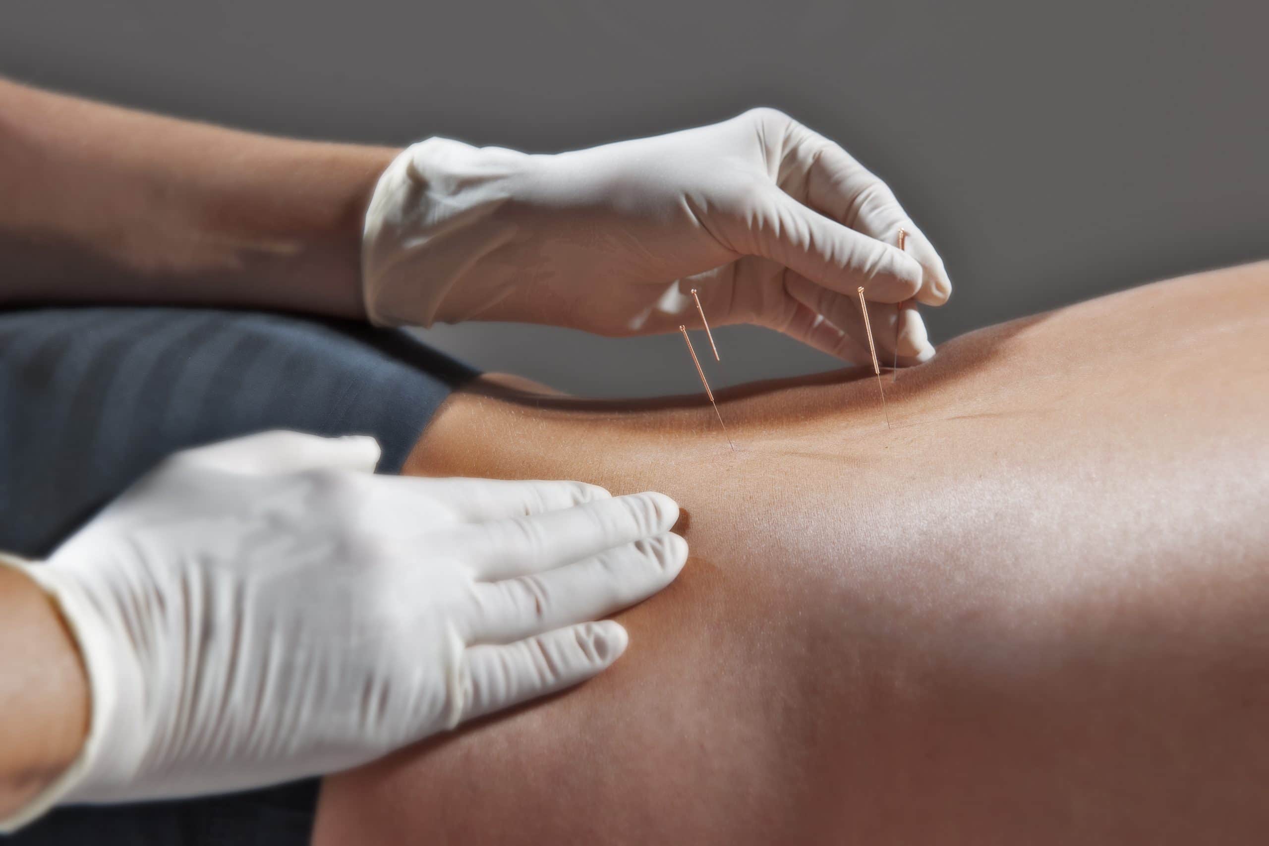Entre tradition et modernité : l’acupuncture au cœur de la guérison