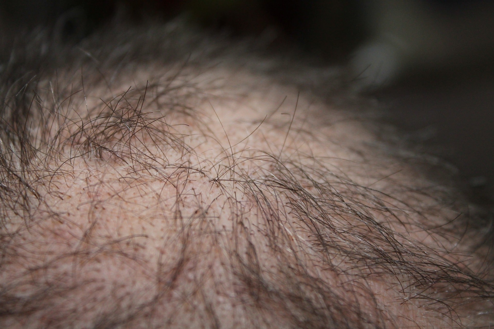 Causes de la chute des cheveux : ce que vous pouvez faire pour y remédier